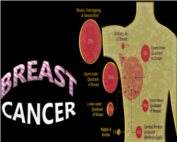 What is the Breast cancer